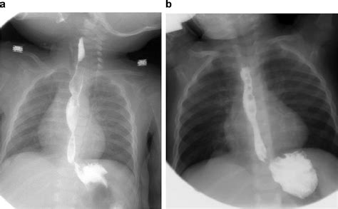 Management and clinical outcomes of congenital esophageal stenosis in ...