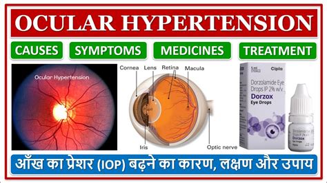 OCULAR HYPERTENSION, आँख का प्रेशर बढ़ने का कारण, लक्षण और उपाय, EYE ...