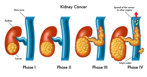 Depositphotos_73928485_original-small - Sunrise Urology