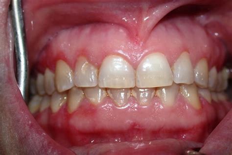 Desquamative gingivitis, definition, causes, symptoms, diagnosis ...