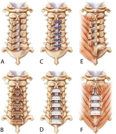 Cervical laminoplasty developments and trends, 2003–2013: a systematic ...