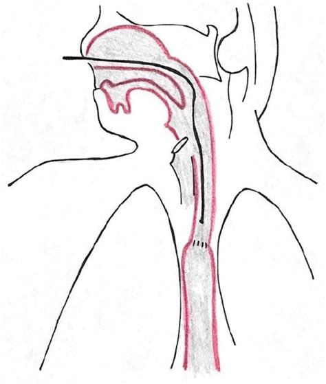 Probe placement esophageal pH-metry. | Download Scientific Diagram