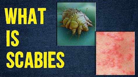 What is Scabies? Scabies Attack | Scabies Eggs on Skin | Diagnosis ...