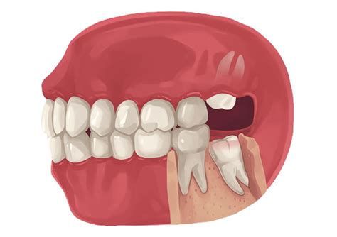 What is Wisdom tooth? - Leading Dental Clinic in Dubai - Best Dentist ...