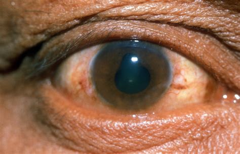 Posterior synechiae - a sign of uveitis. | © International C… | Flickr