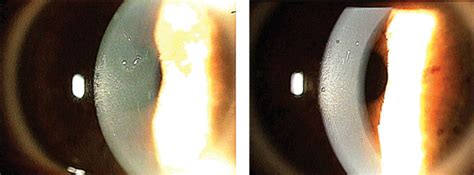 Map Dot Fingerprint Dystrophy Treatment - Maps Model Online