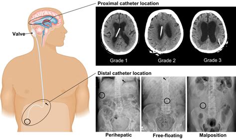 Reducing the risks of proximal and distal shunt failure in adult ...