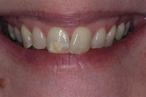 Before and After Dental Bonding Photos | Cosmetic Bonding Dentists