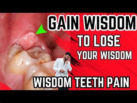 How To Relieve Pain From A Wisdom Tooth - Northernpossession24