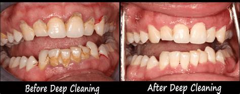 Deep Cleaning of Teeth Side Effects - How to Overcome it?