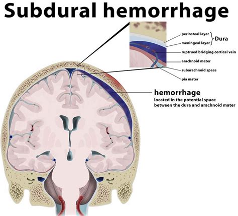 Epidural hematoma causes, signs, symptoms, diagnosis & treatment