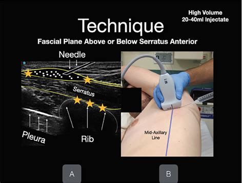 Case Report: Bilateral Ultrasound-guided Serratus Anterior Plane Blocks ...