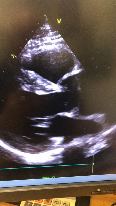 Aortic Dissection TTE : r/Cardiology