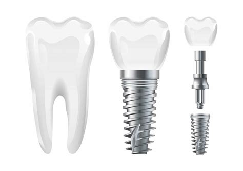 Types of Dental Implants | Which One is Right for You?