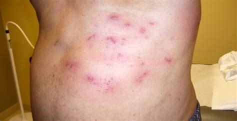 Type 2 diabetic male experiencing painful rash - Journal of Urgent Care ...