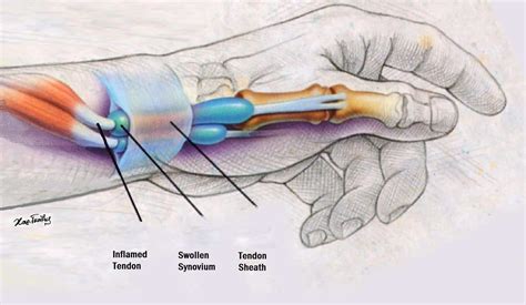 De Quervains Tendonitis