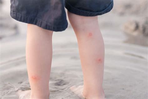 Swollen Mosquito Bites: Causes & Treatment - PestSeek