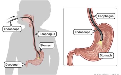 Upper Endoscopy Procedure: A Brief Guide | Doctor Espo