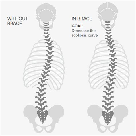 Scoliosis Bracing | Hanger Clinic