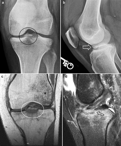 Anterior tibial eminence fracture. a Frontal radiograph shows a ...