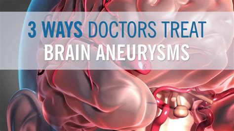 3 Ways Doctors Can Treat Your Brain Aneurysm - YouTube