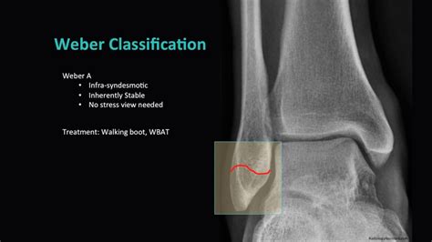 Distal Fibula Fracture