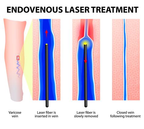 Endovenska radiofrekvenčna metoda - ClosureFast™ - Dermatološki ...