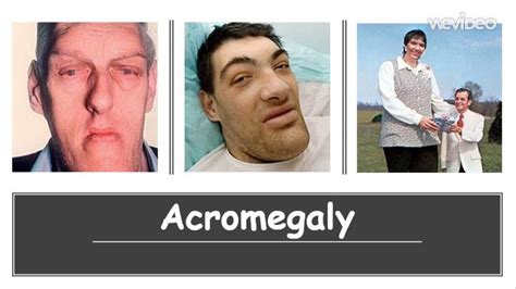 Acromegaly People