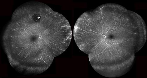 Acute Zonal Occult Outer Reinopathy (AZOOR) – Webvision