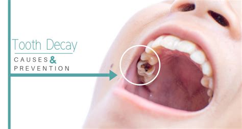 8 Major Causes Of Tooth Decay And How You Can Prevent Them - Photo ...