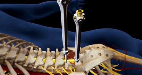 L5-S1 Herniated Disc Surgery - Discseel