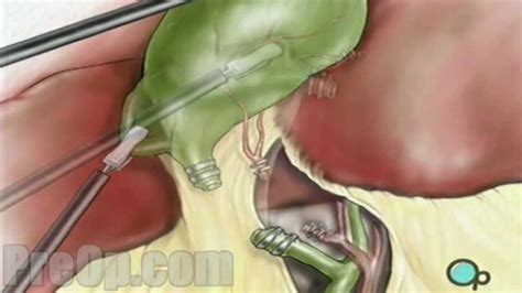 Gallbladder Removal Laparoscopic Surgery Patient Education - YouTube