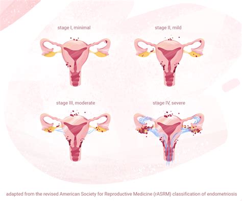 Endometriosis Causes, Symptoms, & Treatment - GoodRx