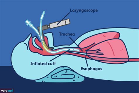 Intubation Explained: Purpose, Risks, and Recovery