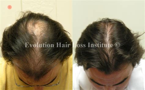 Before and After Hair Growth Treatment Photos