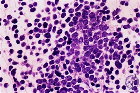 1.Bone marrow / Hematopoietic system (7) Acute lymphoblastic leukemia ...