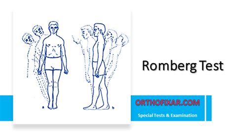 Romberg Test Interpretation Overview 2024