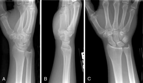 Wrist Apl X Ray / Mr Imaging And Us Of The Wrist Tendons Radiographics ...