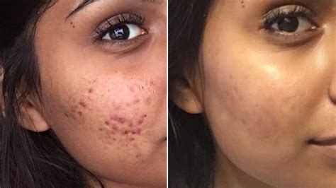 Controversial Cystic Acne Routine Goes Viral — Before-and-After Photos ...