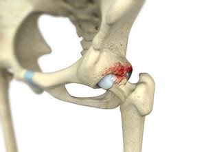 Femoroacetabular Impingement Lee’s Summit | Arthroscopic Hip Surgery ...