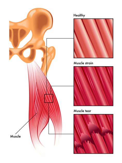 5 Steps to Quickly Recover from Pulled Back Muscles (2022)