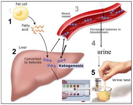 Ketones in Urine Causes, Normal Values, Test Procedure