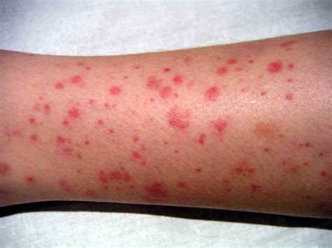 When to Worry about A Rash in Adults? - Page 13 of 15 - Healthella