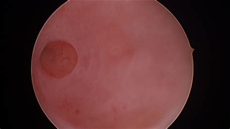 Hysteroscopy Surgery — WA GynaeScope | Gynaecologists | Fertility ...