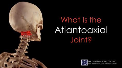 What Is the Atlantoaxial Joint? - Centeno-Schultz Clinic