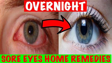 How To Get Rid Of Sore Eyes Naturally? 14 Effective Natural Home ...