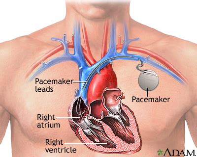 Heart pacemaker: MedlinePlus Medical Encyclopedia