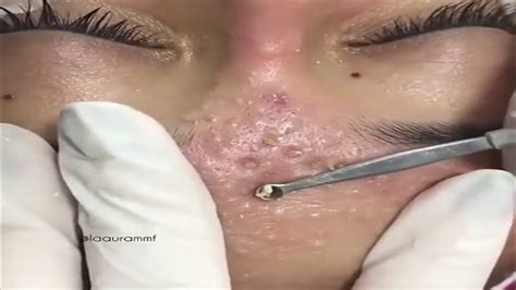 #AcneExtraction New Pimple Popping Blackheads Removing #6 - YouTube