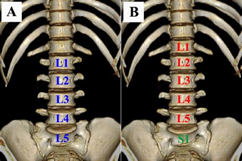 Figure 2 from The association between lumbar rib and lumbosacral ...