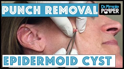 Sebaceous Cyst Face Removal